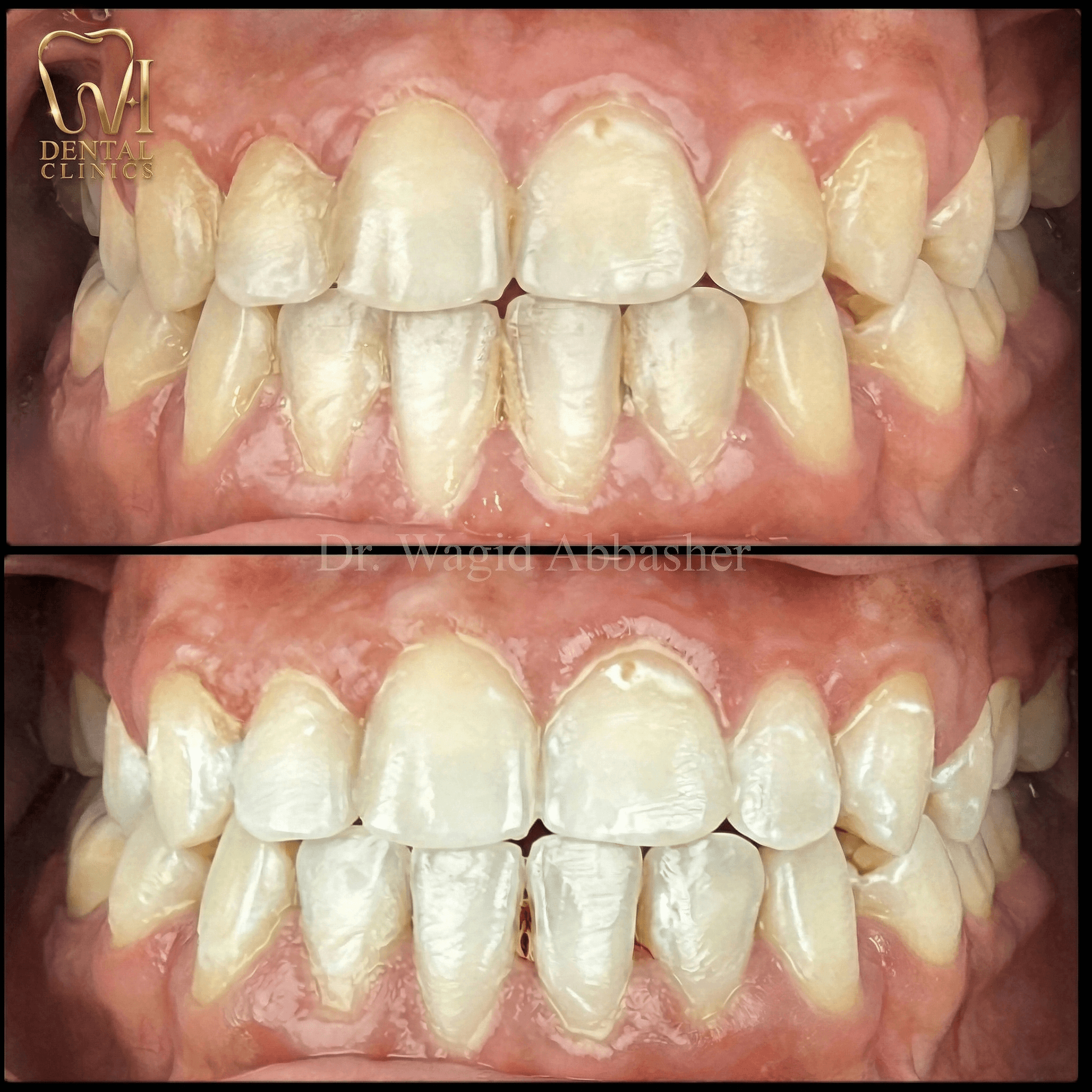 تجديد الابتسامة — W.I للأسنان