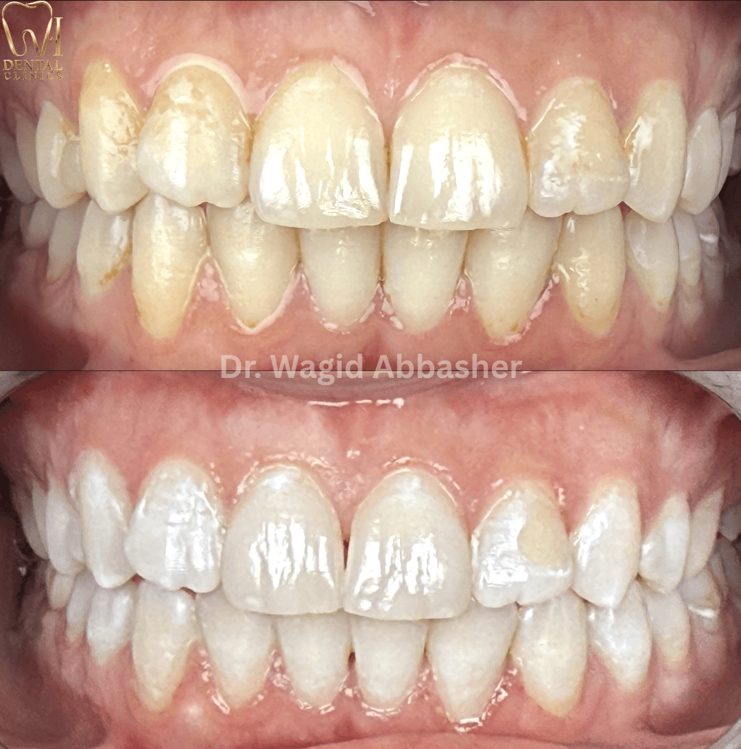 ربط تجميلي — W.I للأسنان