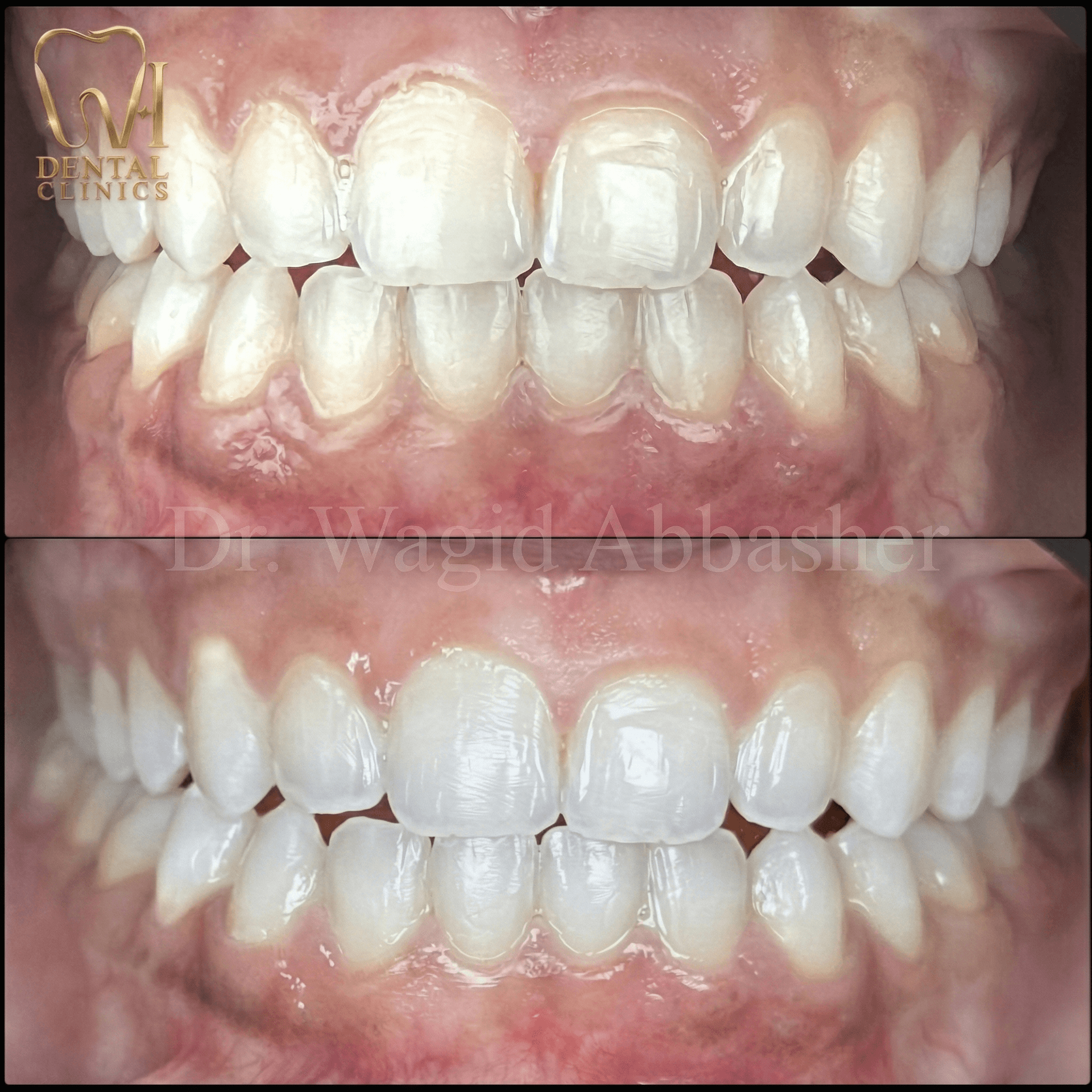 إعادة تصميم كاملة للابتسامة — W.I للأسنان