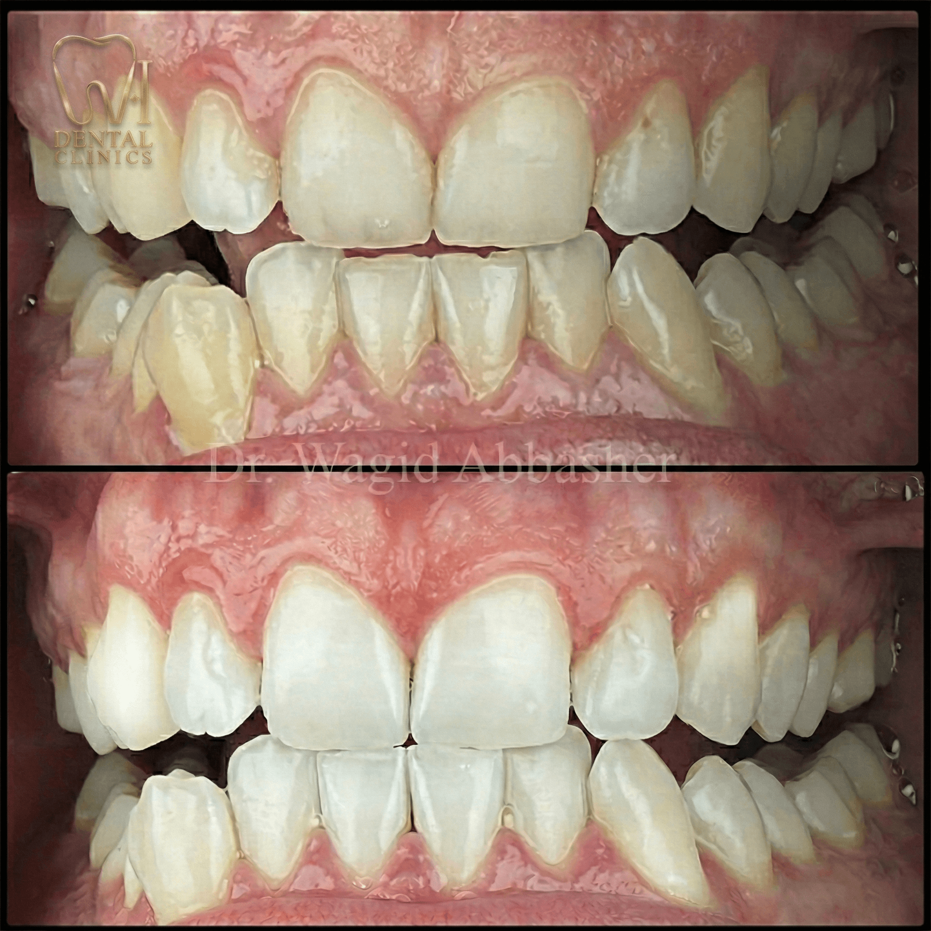 تبييض + قشور — W.I للأسنان