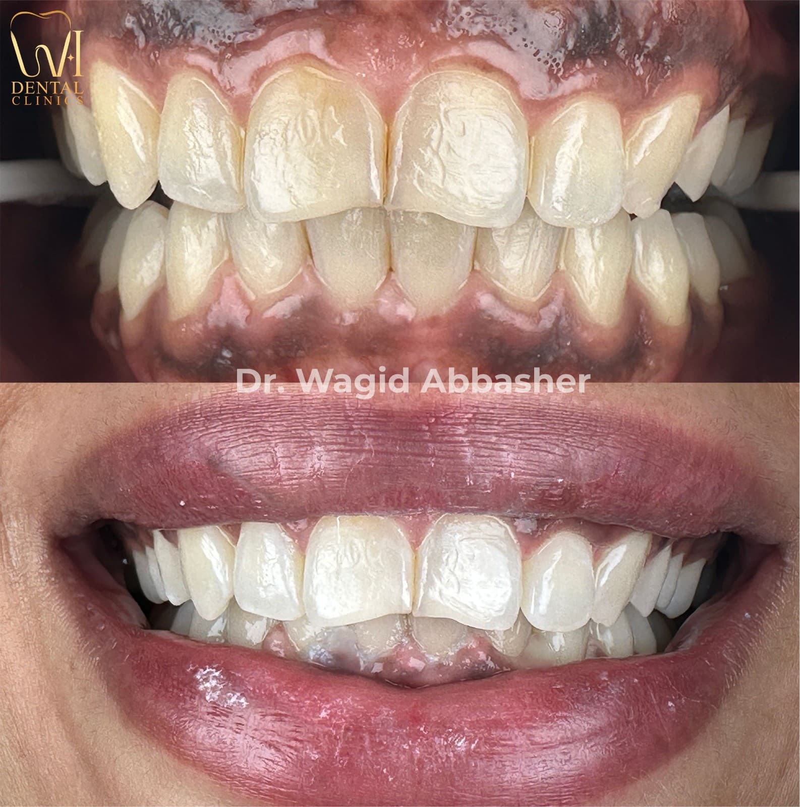 ابتسامة هوليود — W.I للأسنان