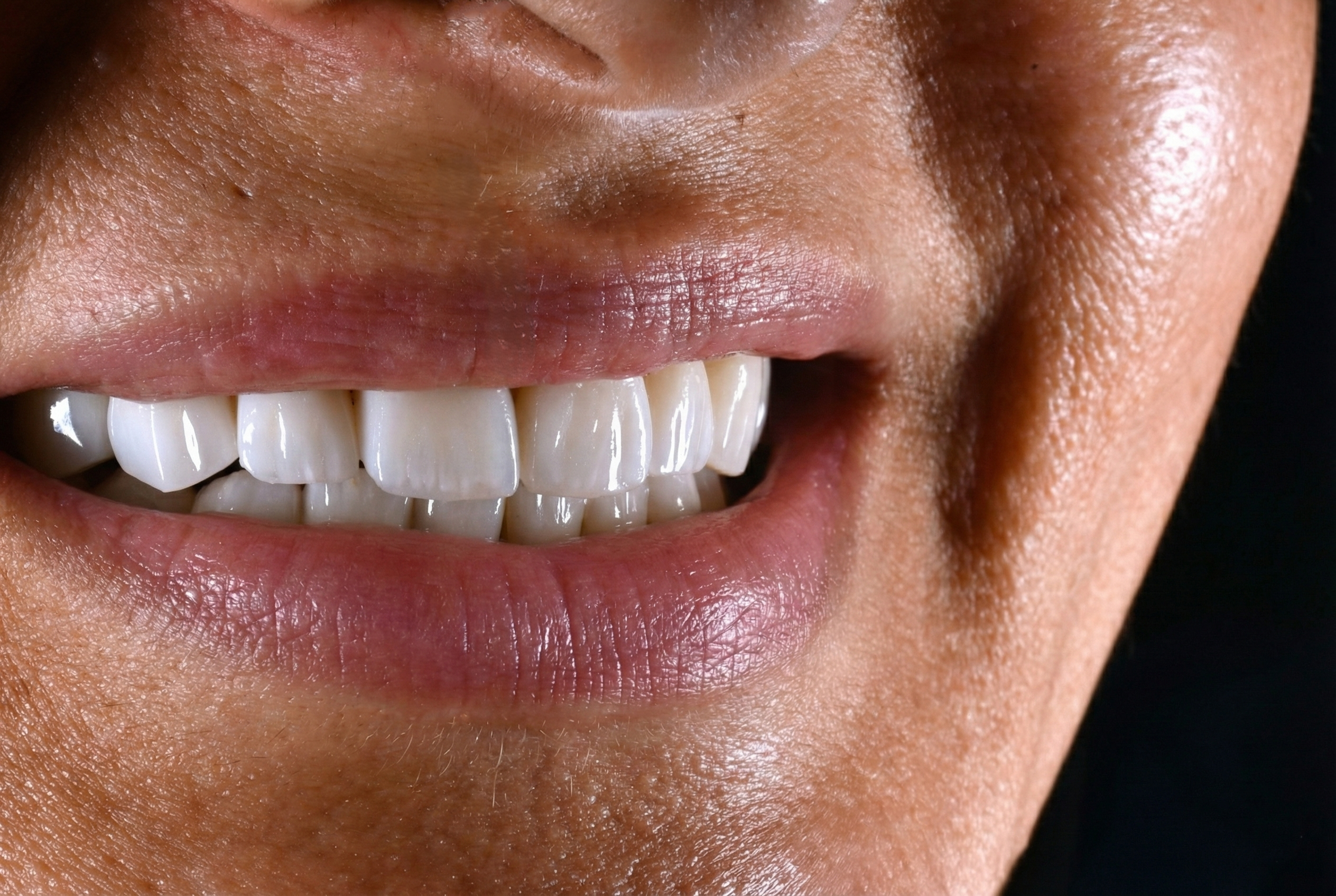Hollywood Smile before