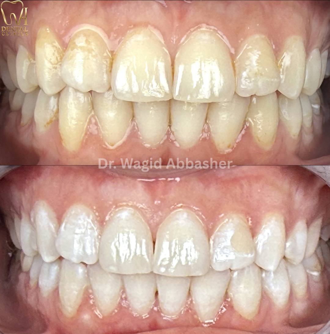 Clear Aligners before